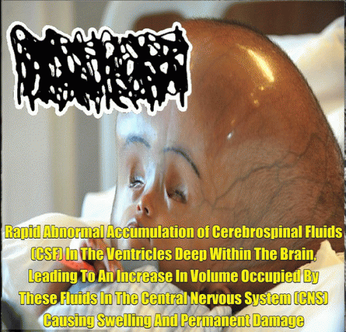 Hydrocephalus : Rapid Abnormal Accumulation of Cerebrospinal Fluids (Csf) in the Ventricles Deep Within the Brain, L